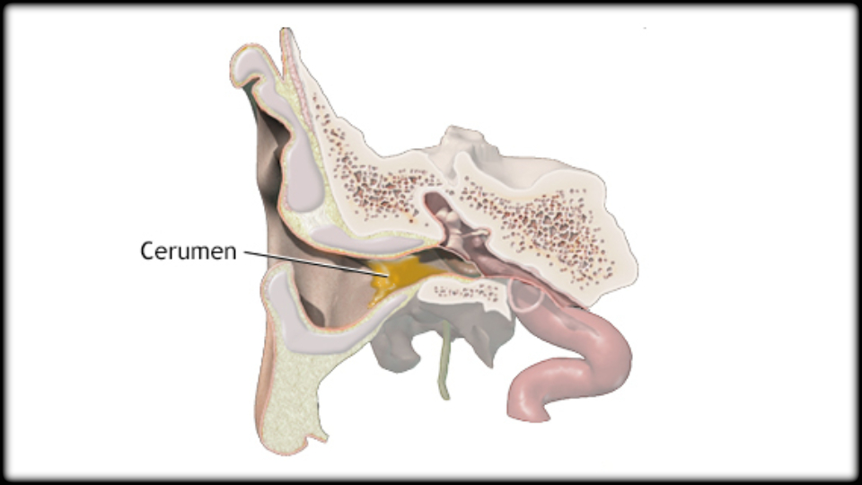 Earwax or Fluid Buildup