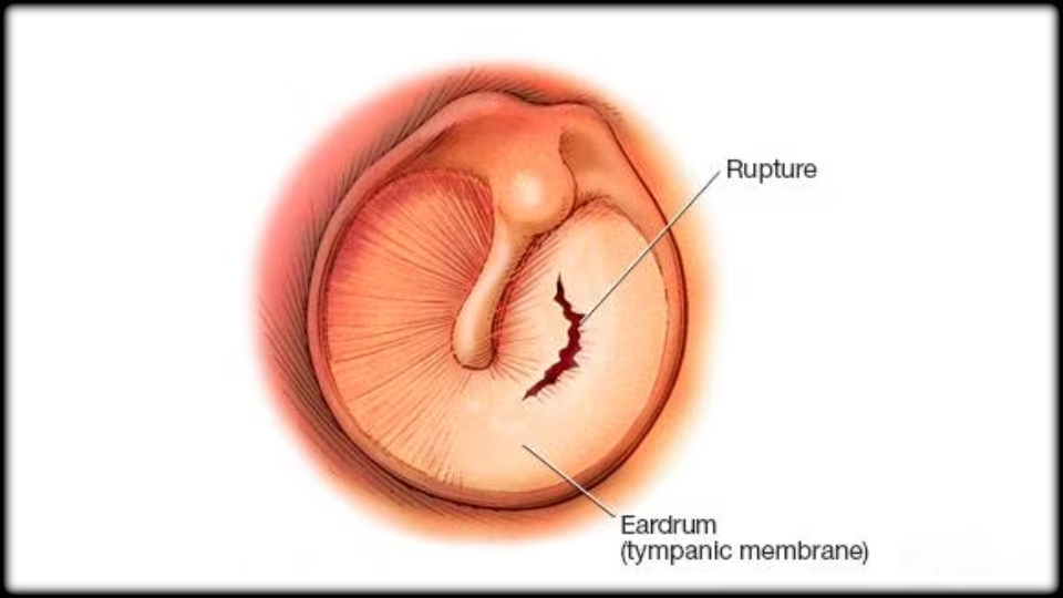 Ruptured Eardrum