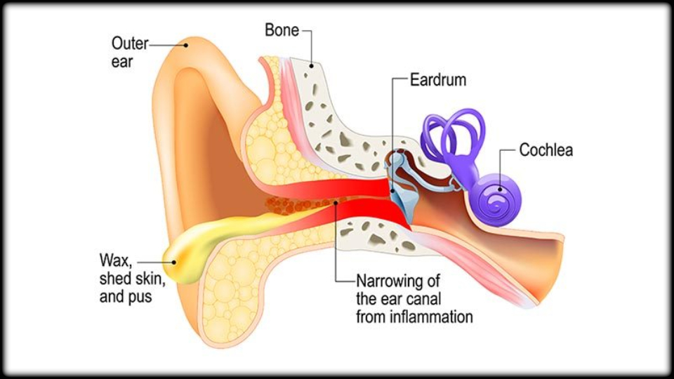 Otitis Externa